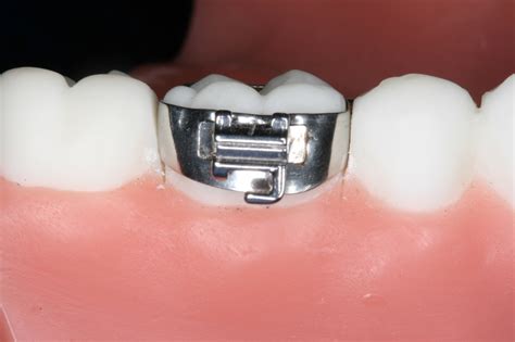 can you bond bracket to metal band|Dealing with brackets that will not stay attached to crowns .